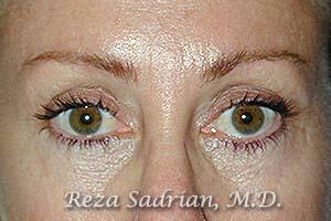 Blepharoplasty Before & After Image