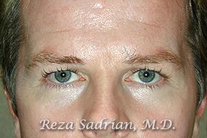 Blepharoplasty Before & After Image