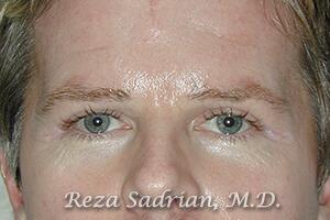 Blepharoplasty Before & After Image