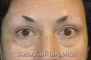 Blepharoplasty Before & After Image