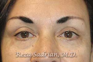 Blepharoplasty Before & After Image