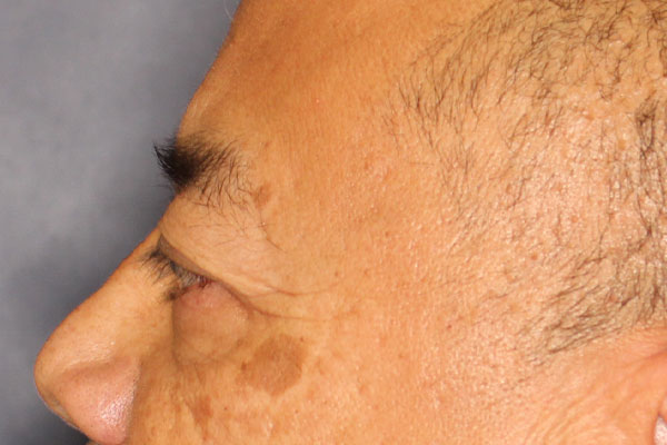 Blepharoplasty Before & After Image