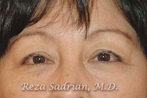 Blepharoplasty Before & After Image