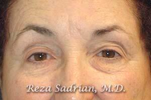 Blepharoplasty Before & After Image