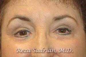 Blepharoplasty Before & After Image