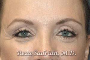 Blepharoplasty Before & After Image