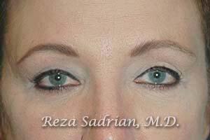 Blepharoplasty Before & After Image