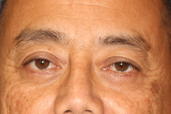 Blepharoplasty Before & After Image