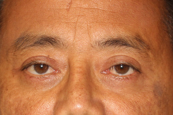 Blepharoplasty Before & After Image