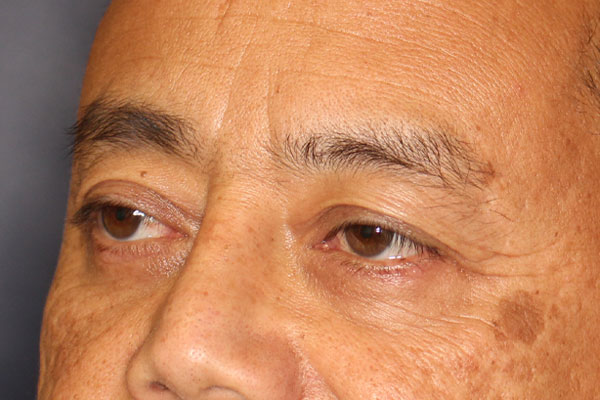 Blepharoplasty Before & After Image