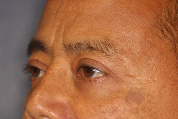 Blepharoplasty Before & After Image