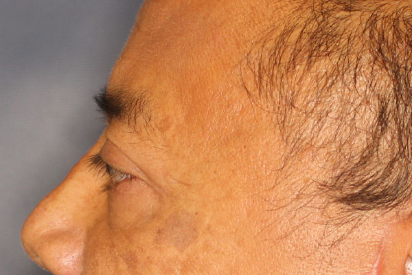 Blepharoplasty Before & After Image