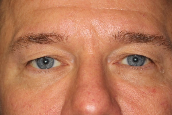 Blepharoplasty Before & After Image