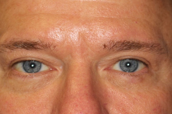 Blepharoplasty Before & After Image