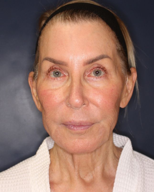 Blepharoplasty Before & After Image