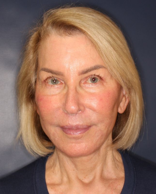 Blepharoplasty Before & After Image