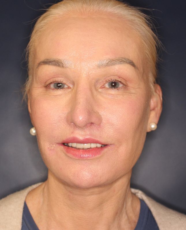 Blepharoplasty Before & After Image