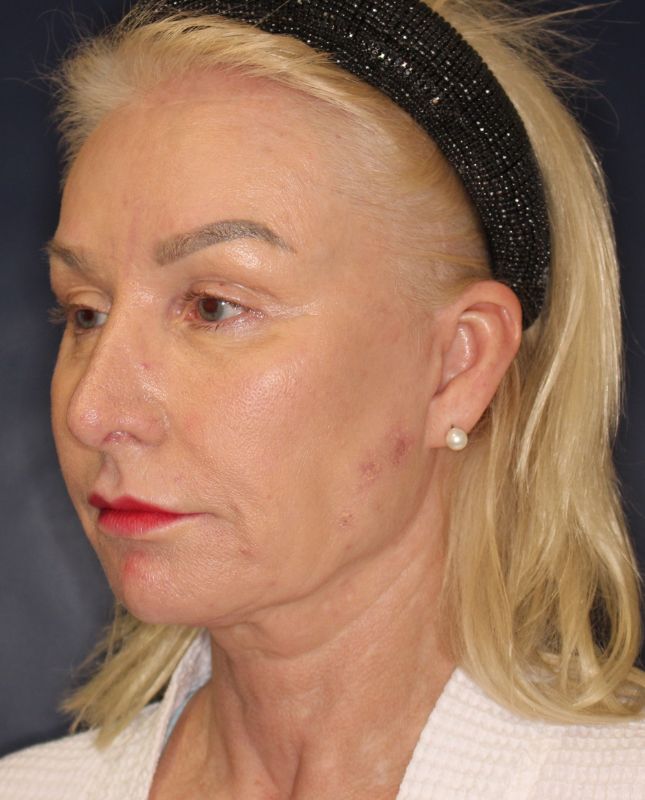Blepharoplasty Before & After Image