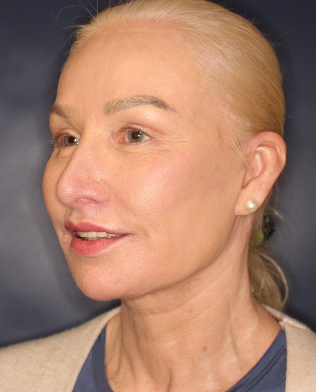 Blepharoplasty Before & After Image