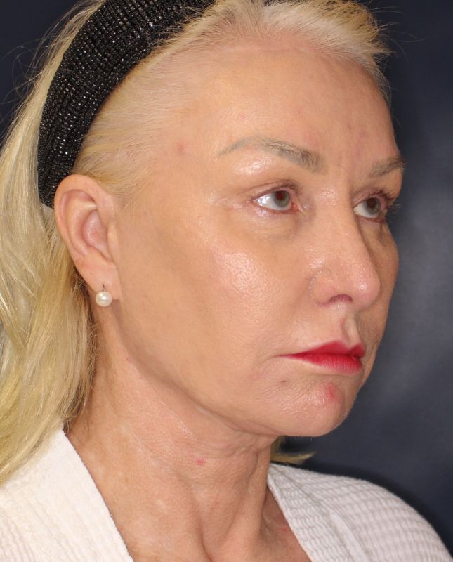 Blepharoplasty Before & After Image