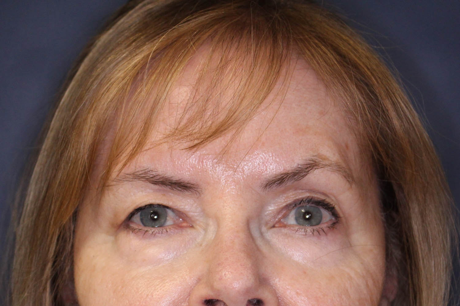 Blepharoplasty Before & After Image
