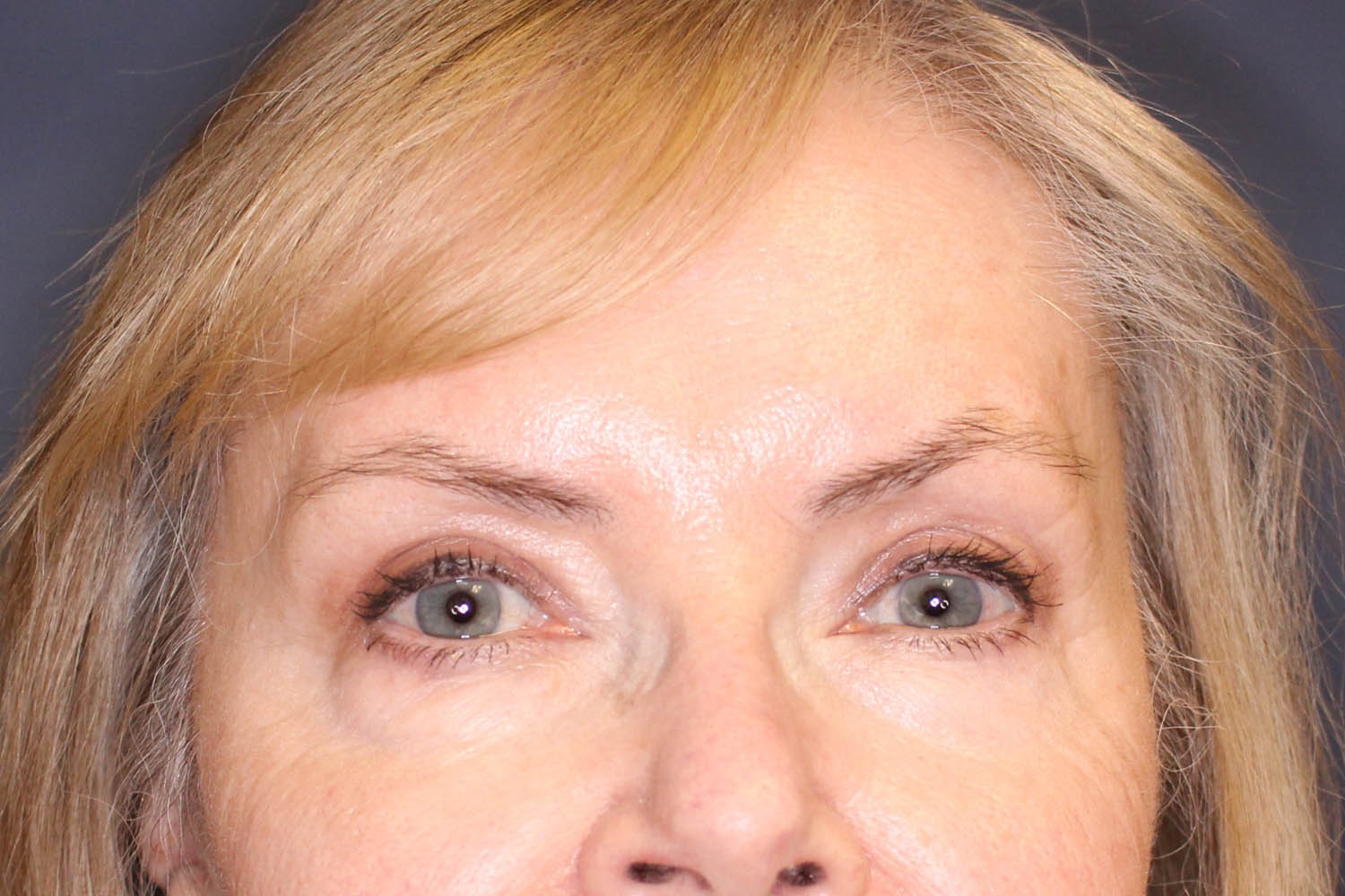 Blepharoplasty Before & After Image