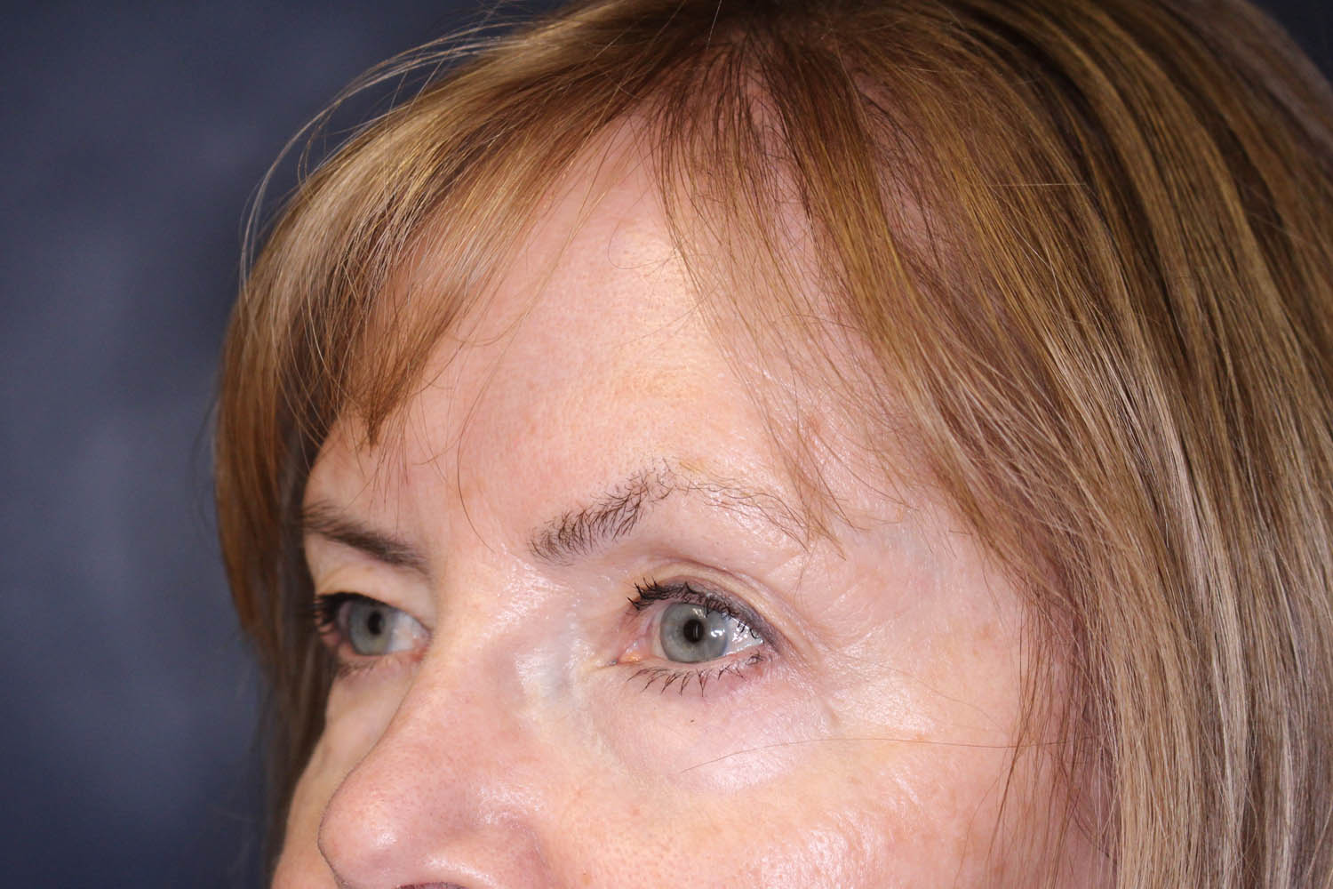 Blepharoplasty Before & After Image