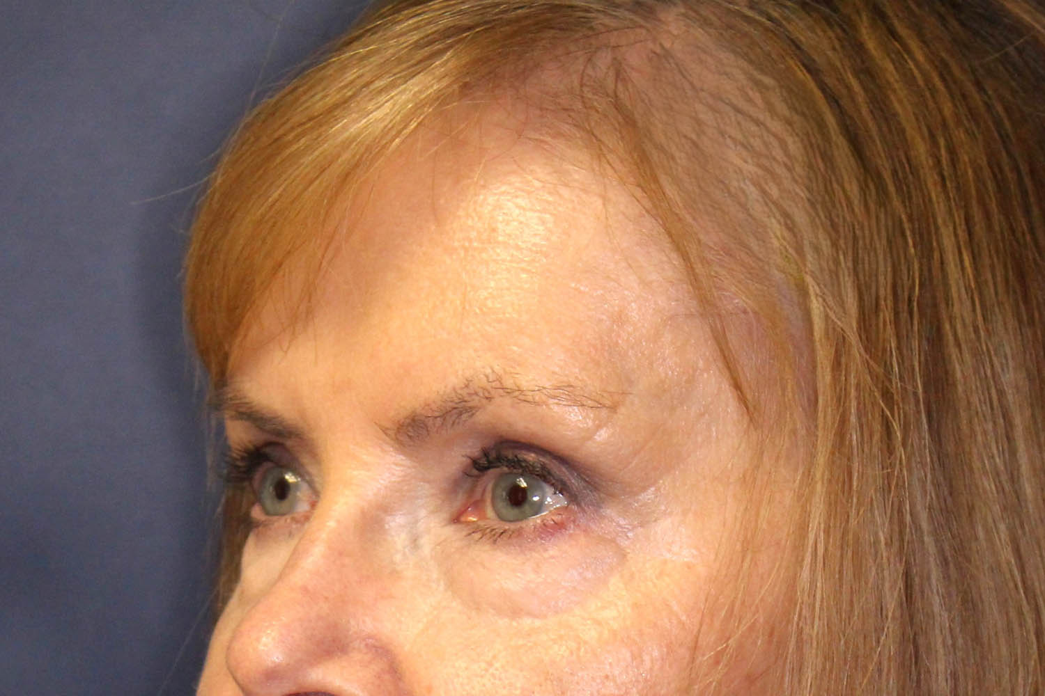 Blepharoplasty Before & After Image