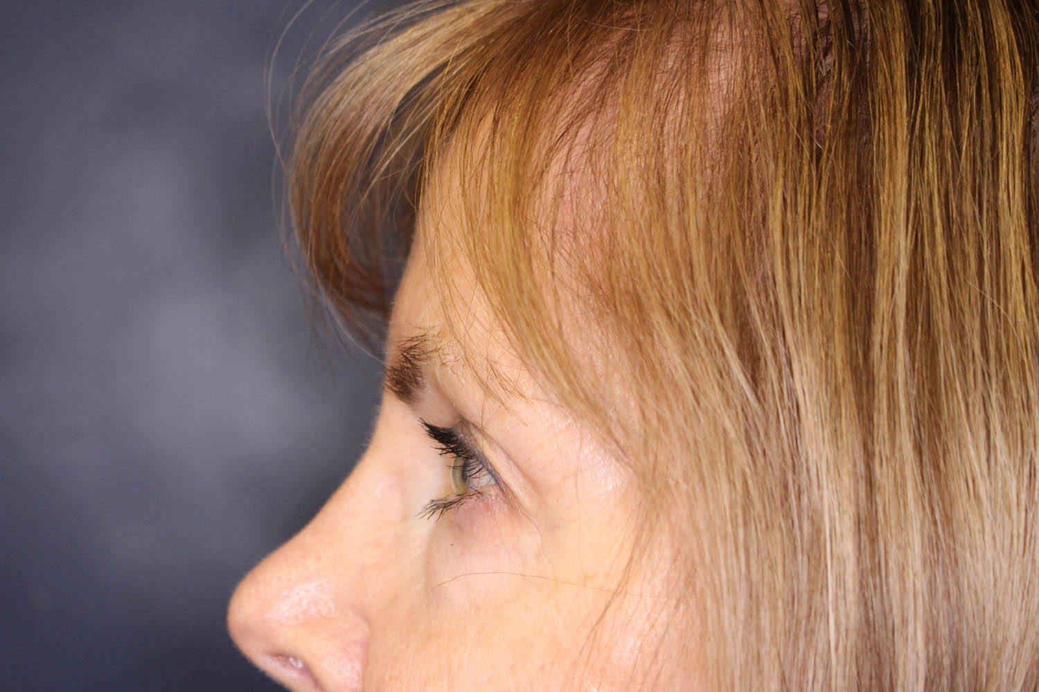 Blepharoplasty Before & After Image