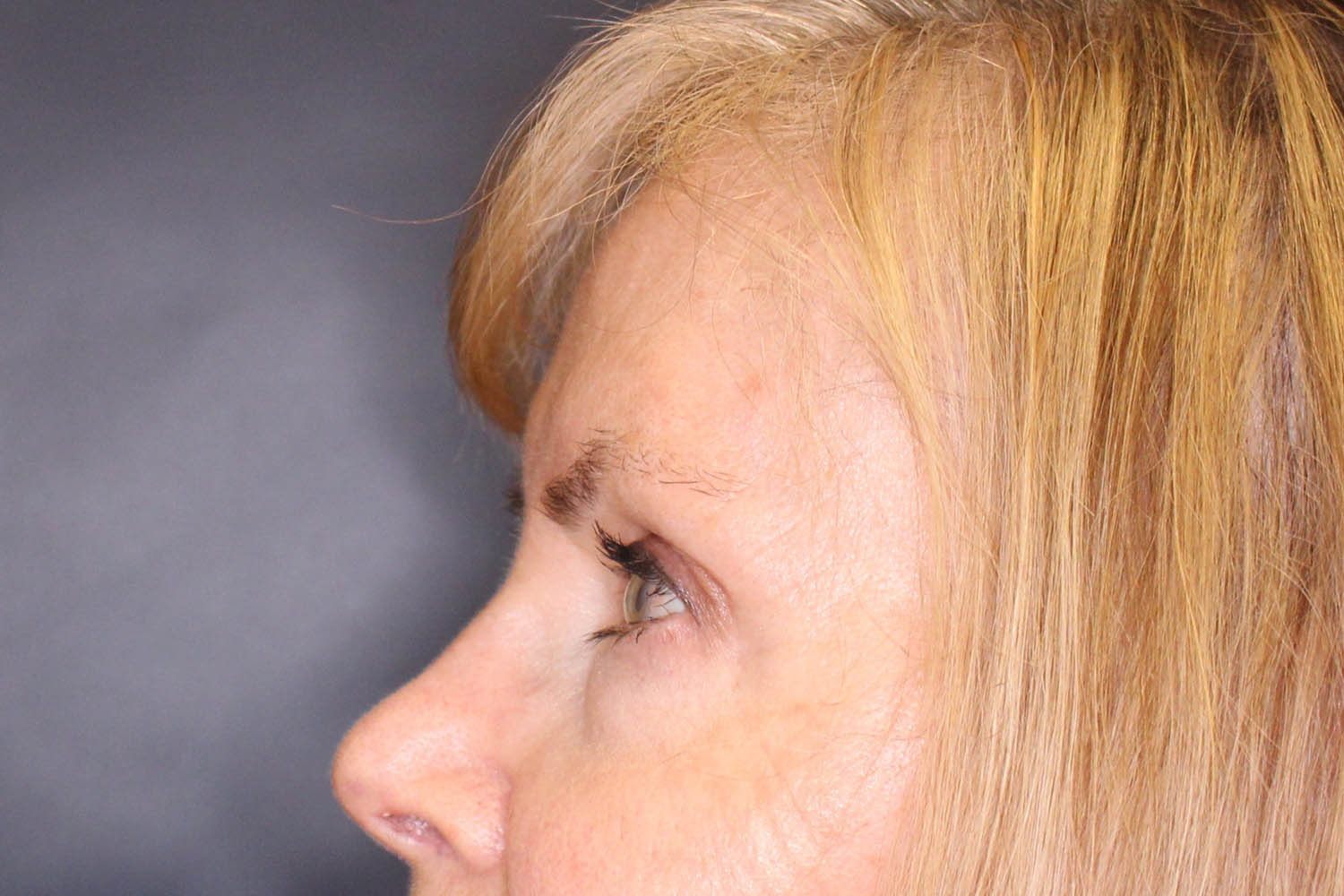 Blepharoplasty Before & After Image