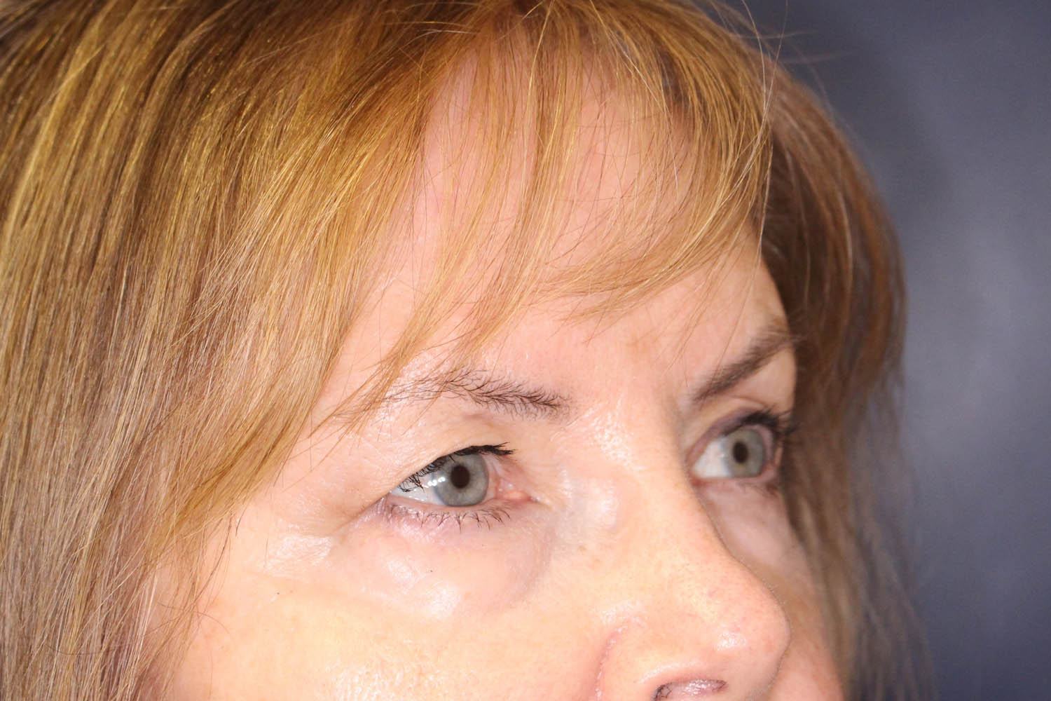 Blepharoplasty Before & After Image
