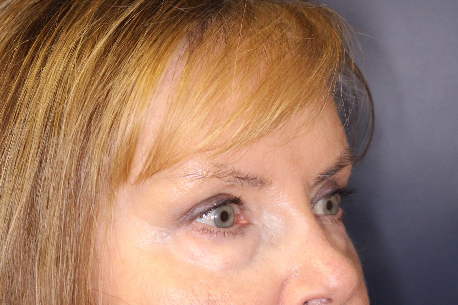 Blepharoplasty Before & After Image