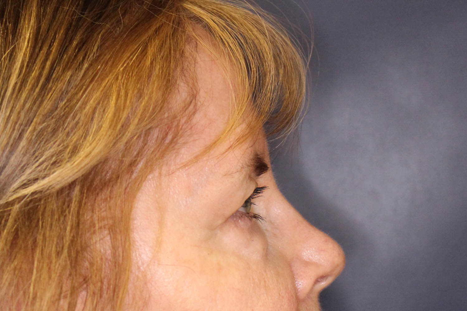Blepharoplasty Before & After Image