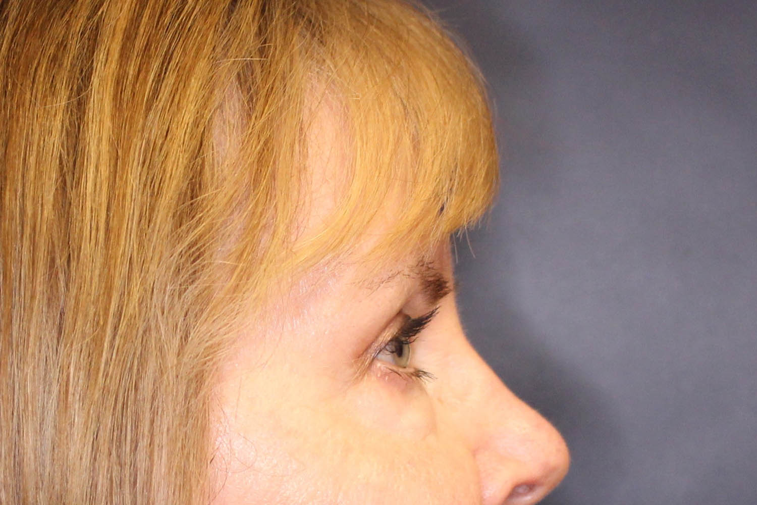 Blepharoplasty Before & After Image