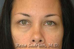 Brow Forehead Lift Before & After Image