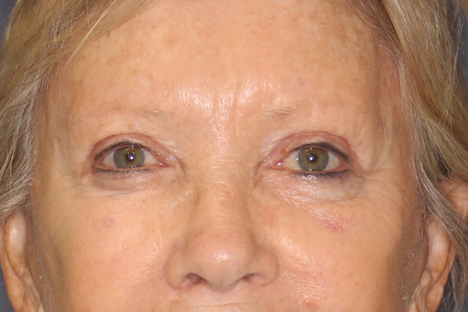 Brow Forehead Lift Before & After Image