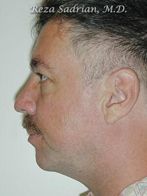 Chin Cheek Enhancement Before & After Image