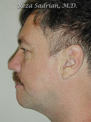 Chin Cheek Enhancement Before & After Image