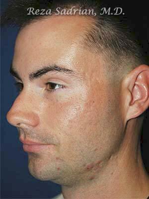 Chin Cheek Enhancement Before & After Image