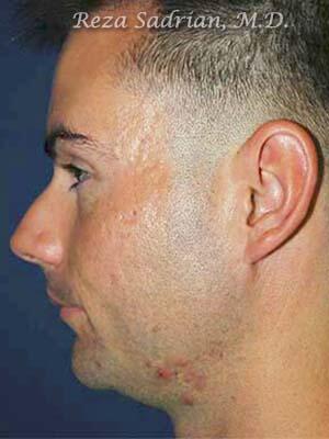 Chin Cheek Enhancement Before & After Image