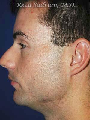 Chin Cheek Enhancement Before & After Image