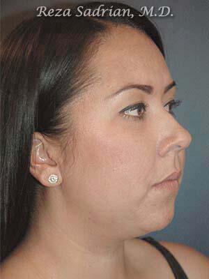 Chin Cheek Enhancement Before & After Image