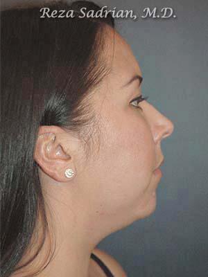 Chin Cheek Enhancement Before & After Image