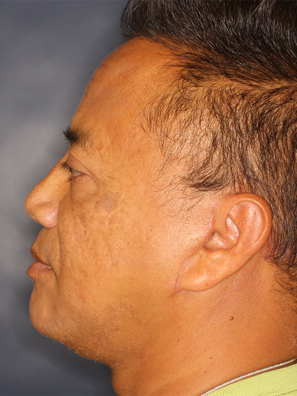 Chin Cheek Enhancement Before & After Image