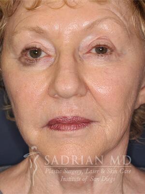 Face & Neck Lift Before & After Image