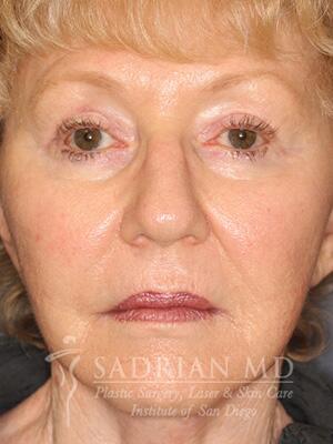 Face & Neck Lift Before & After Image