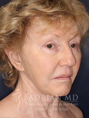 Face & Neck Lift Before & After Image