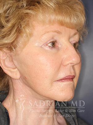 Face & Neck Lift Before & After Image