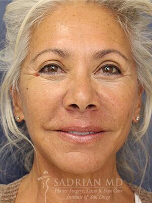 Face & Neck Lift Before & After Image