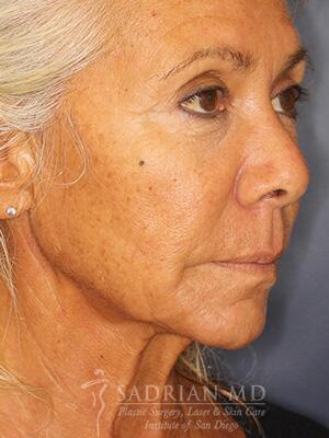 Face & Neck Lift Before & After Image